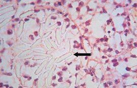 纖維素性炎 纖維素性炎