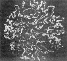 小兒過敏性紫癜性腎炎