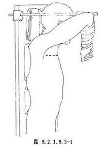 第一肋骨切除術 第一肋骨切除術