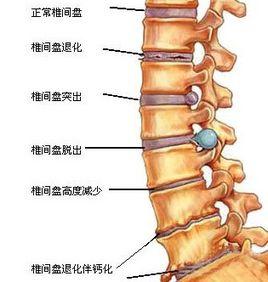 腰椎間盤鈣化 腰椎間盤鈣化