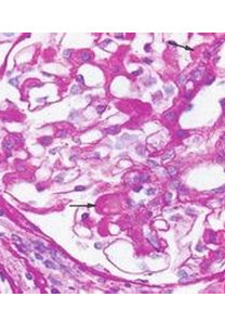 急性腎小球腎炎 急性腎小球腎炎