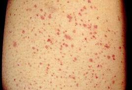 慢性過敏性紫癜 慢性過敏性紫癜