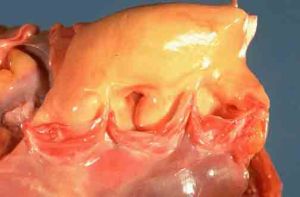 老年人多器官功能衰竭