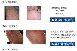 鱗屑型腳氣 鱗屑型腳氣