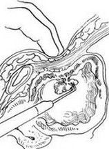 經尿道膀胱腫瘤電切術