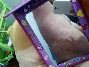 中毒性紅斑 中毒性紅斑