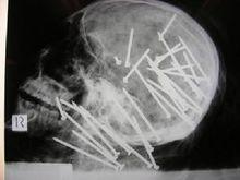 澳大利亞警方公布了劉辰頭部X光片