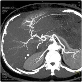 肝內鈣化斑 肝內鈣化斑