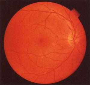 視網膜震盪