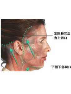 拉皮除皺 拉皮除皺