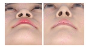 鼻孔改形術