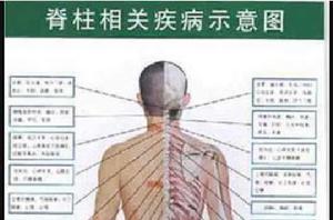 脊柱相關疾病示意圖 脊柱相關疾病示意圖
