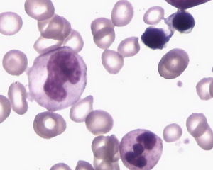 巨幼紅細胞性貧血