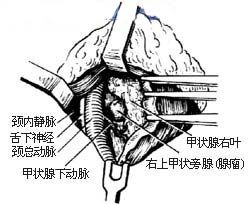 甲狀旁腺切除術 甲狀旁腺切除術