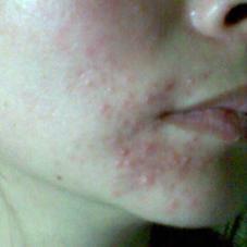 過敏型痘痘 過敏型痘痘