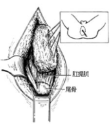 會陰下降綜合徵