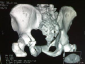 髖臼骨折 髖臼骨折