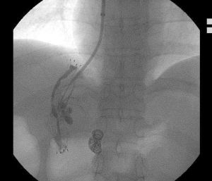 超聲精囊穿刺造影術 超聲精囊穿刺造影術