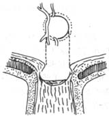 原發性開角型青光眼