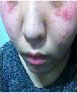 面部過敏 面部過敏