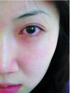 病毒性結膜炎 病毒性結膜炎