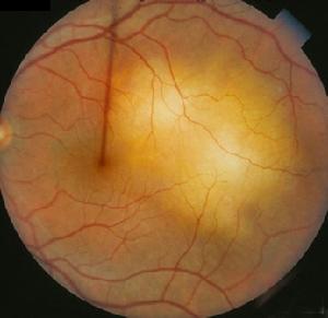 WEGNER肉芽腫 WEGNER肉芽腫