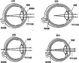 眼睛屈光 眼睛屈光