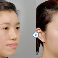 鼻頭縮小手術 鼻頭縮小手術