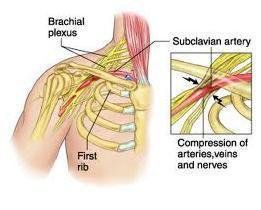 前斜角肌 前斜角肌