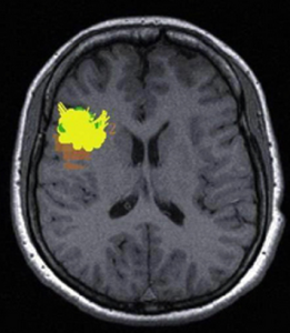 交通性腦積水 交通性腦積水
