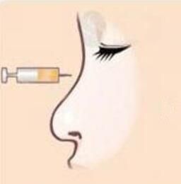 自體脂肪隆鼻 自體脂肪隆鼻