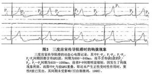完全性房室傳導阻滯