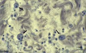 慢性阿米巴痢疾鏡檢