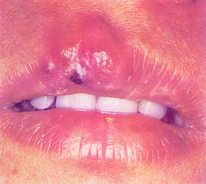 口腔皰疹 口腔皰疹