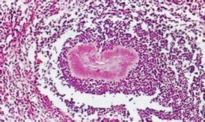 肉芽腫性炎 肉芽腫性炎