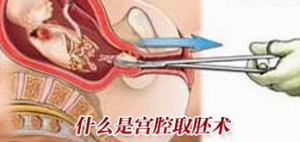 宮腔取胚術