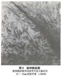 特發性黃斑部前膜