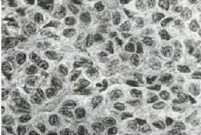 卵巢顆粒細胞瘤