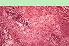膀胱鱗狀細胞癌