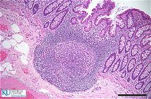 派爾集合淋巴結