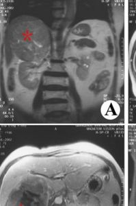 腎上腺皮質癌 腎上腺皮質癌