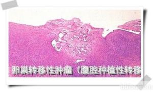 腫瘤種植轉移 腫瘤種植轉移