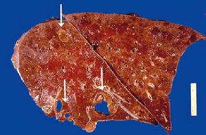 鸚鵡熱衣原體肺炎