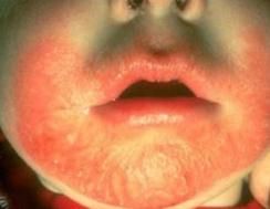 離位皮炎 離位皮炎