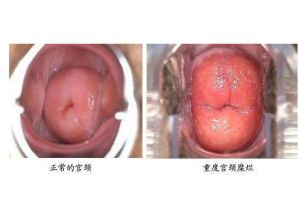 宮頸糜爛三度 宮頸糜爛三度