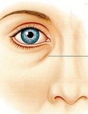 祛眼袋手術 祛眼袋手術