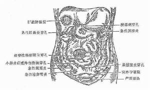 急性瀰漫性腹膜炎 急性瀰漫性腹膜炎