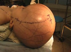 老年人正常壓力腦積水 老年人正常壓力腦積水