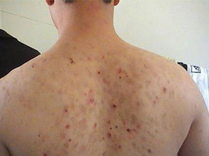 副銀屑病 副銀屑病