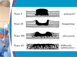 胃竇腺癌 胃竇腺癌